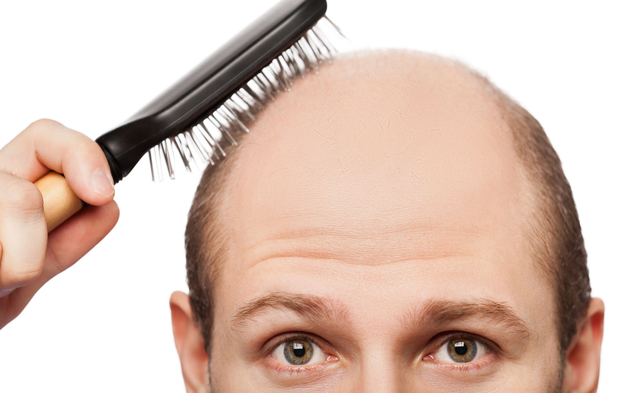 9 причин выпадения волос у мужчин | Способы остановить облысение